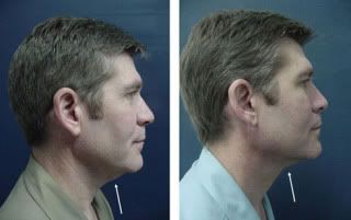 lipo 13