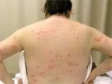 bed bug bites on back Pictures, Images and Photos